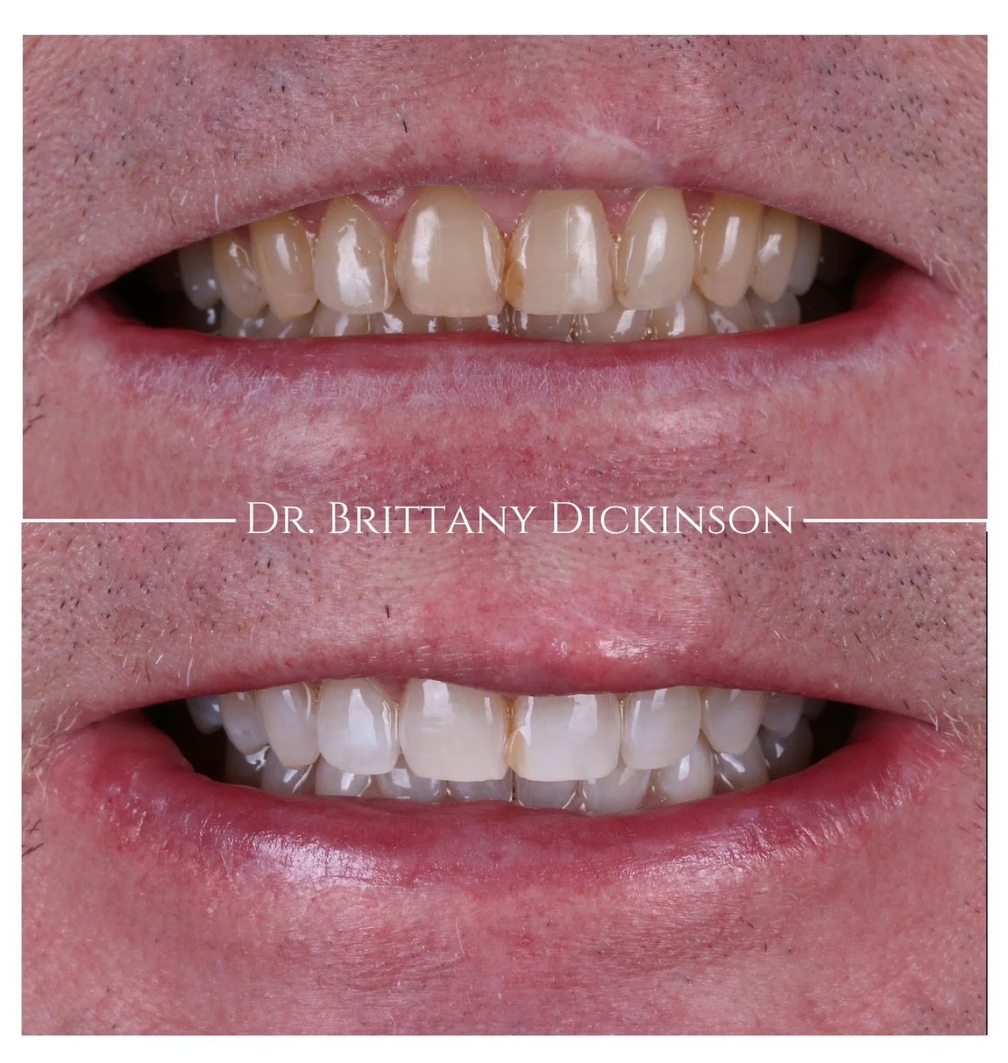 Zoom whitening before and after by Dr. Brittany Dickinson, Chicago Aesthetic Dentistry, Lakeview.