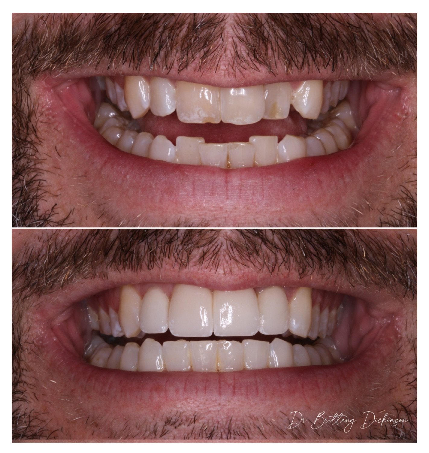 Invisalign zoom whitening and 4 porcelain veneers before and after by Dr. Brittany Dickinson, Chicago Aesthetic Dentistry.