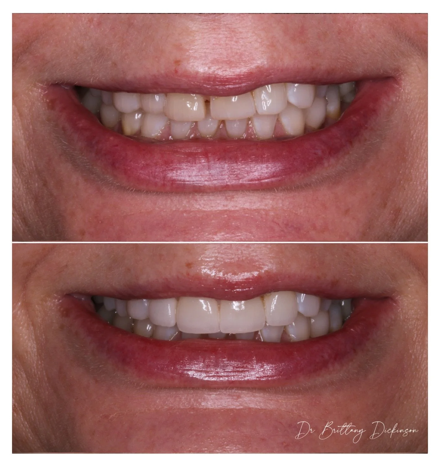 4 porcelain veneers to correct asymmetry and close a gap by Dr. Brittany Dickinson — Chicago Lakeview.