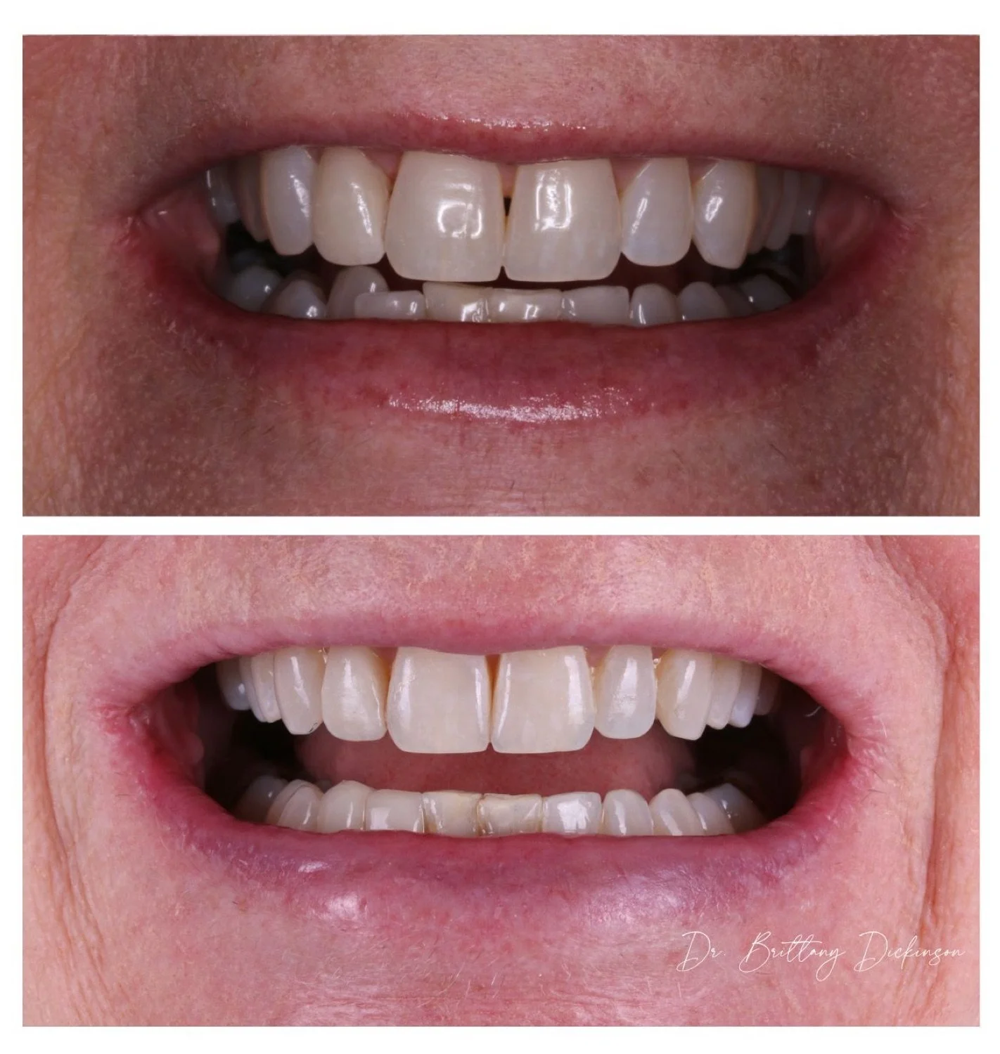 Invisalign zoom whitening and 3 porcelain veneers before and after by Dr. Brittany Dickinson, Chicago Aesthetic Dentistry.