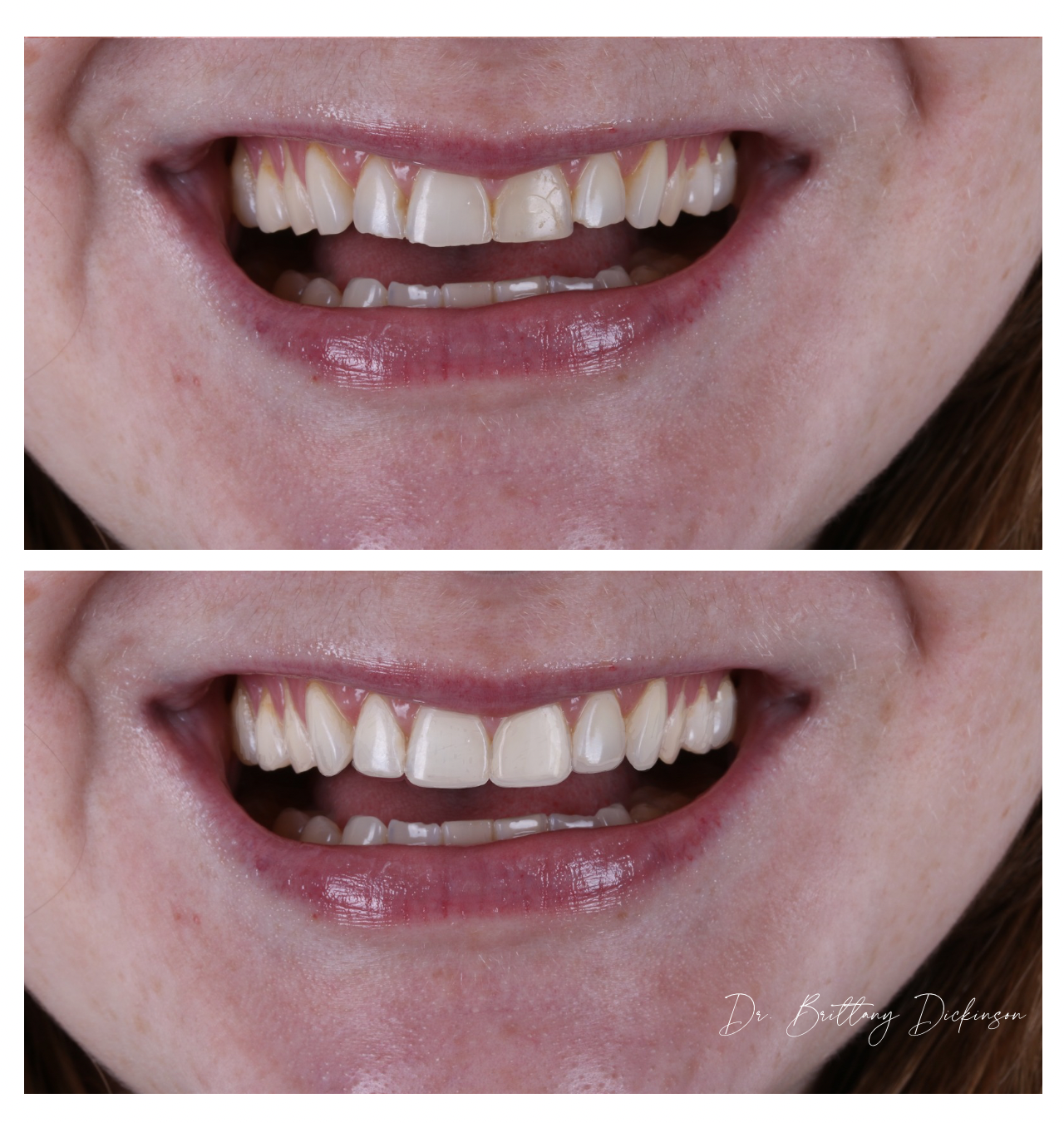 Cosmetic bonding before and after — Chicago Aesthetic Dentistry, Lakeview