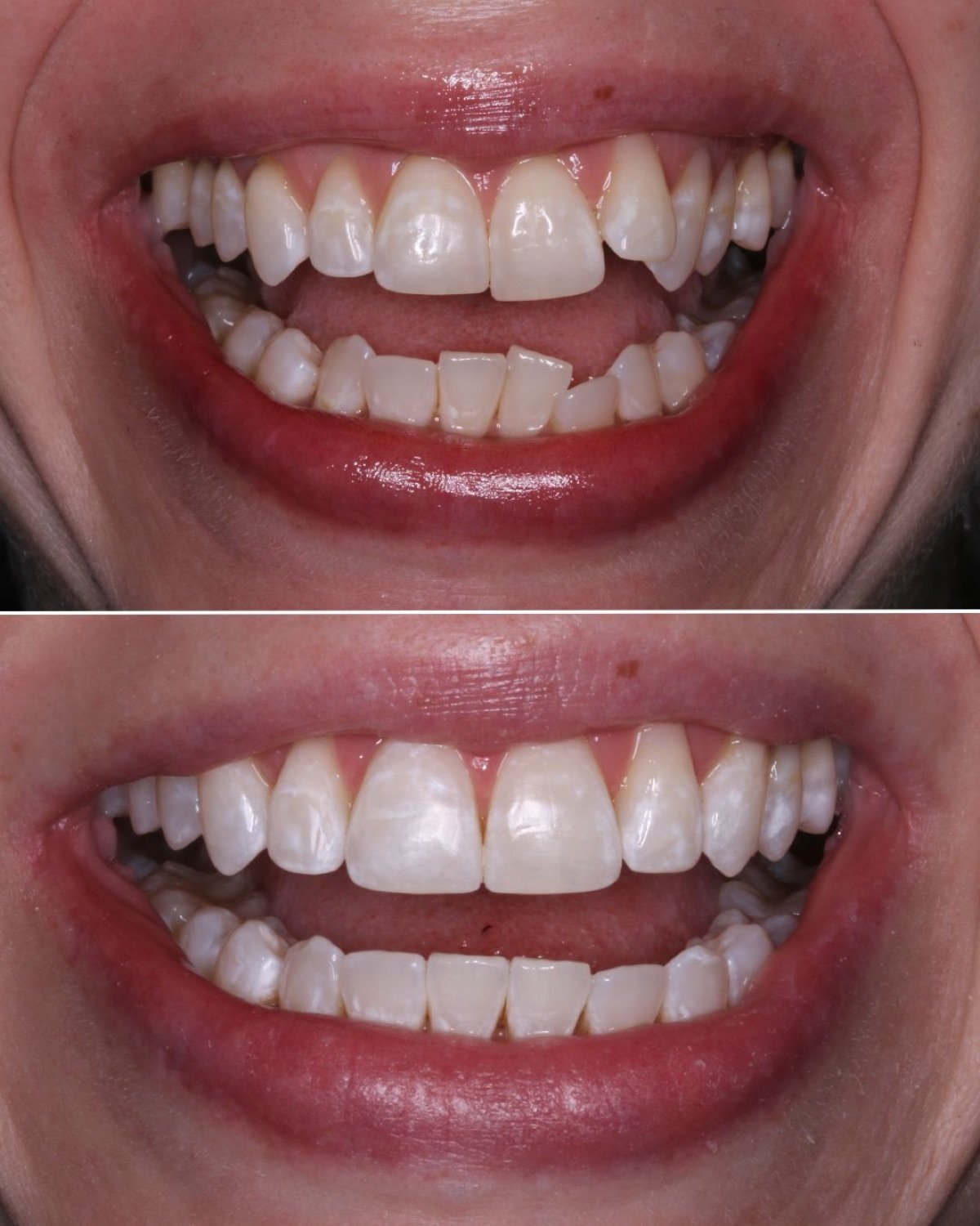 Invisalign before and after by Dr. Brittany Dickinson — rotation, crowding, flared tooth corrected, Chicago.