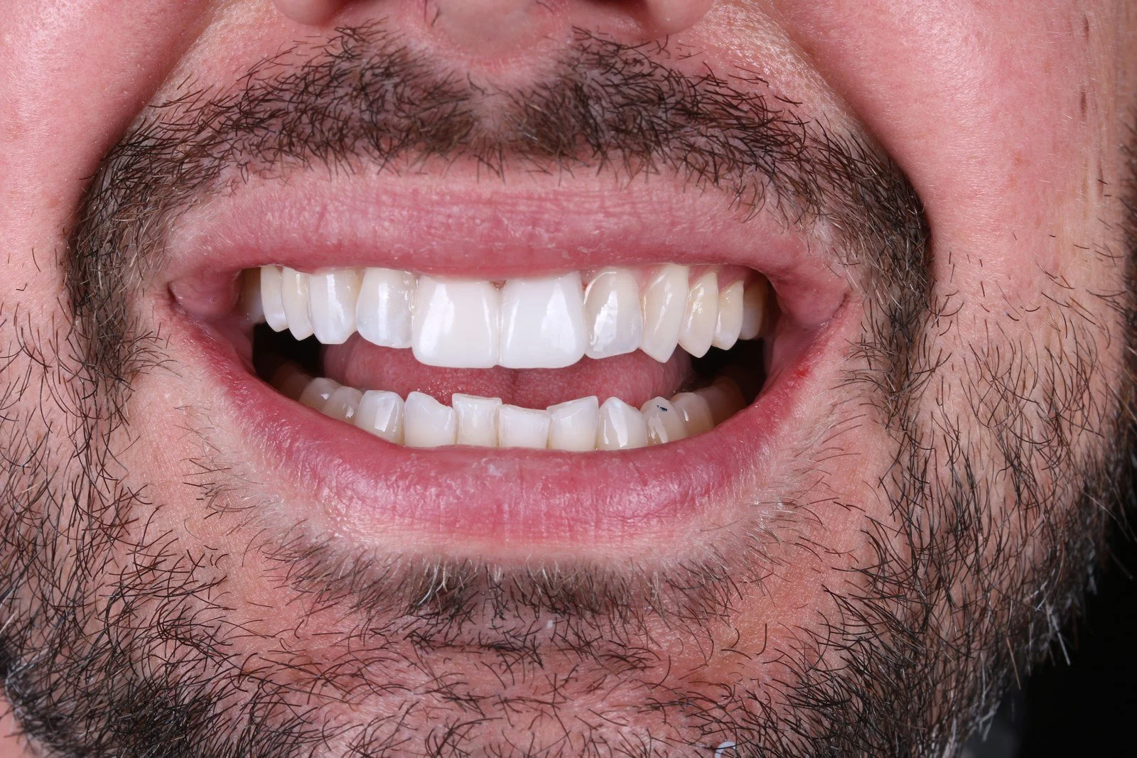 the step by step guide to porcelain veneers, straightening crooked teeth and restoring wear.