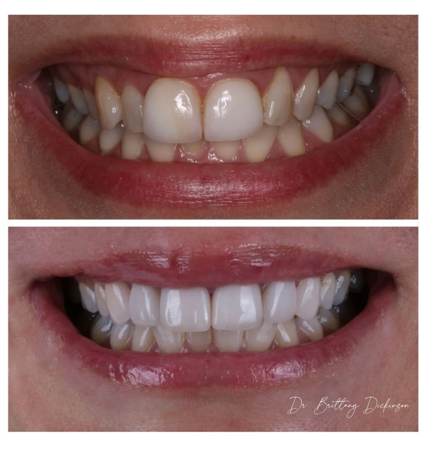 6 porcelain veneers before and after by Dr. Brittany Dickinson, Chicago Aesthetic Dentistry, Lakeview.