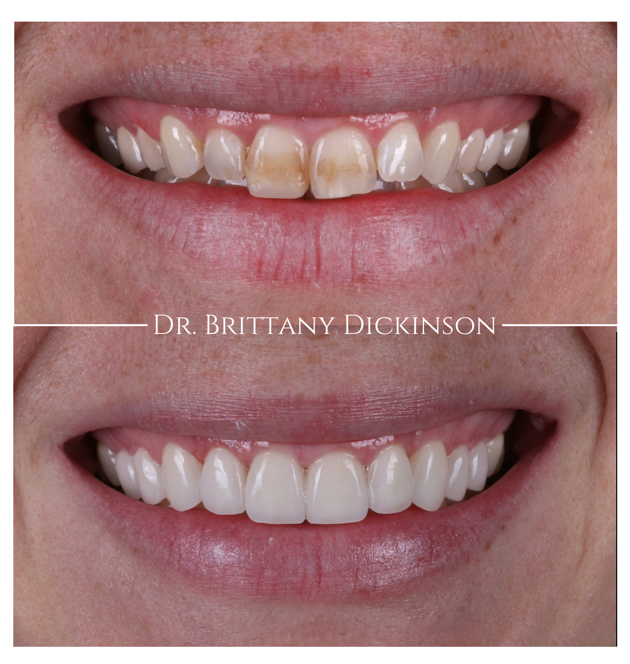 Smile makeover combining Invisalign and whitening, designed by Dr. Brittany Dickinson in Chicago.