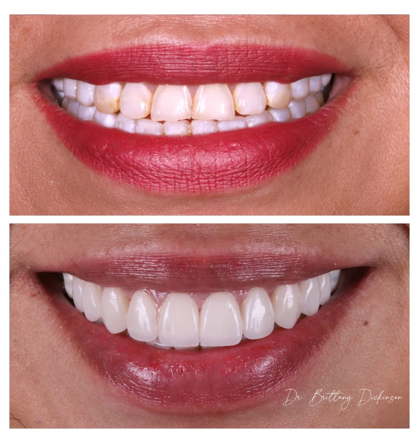 10 porcelain veneers before and after by Dr. Brittany Dickinson, Chicago Aesthetic Dentistry, Lakeview.