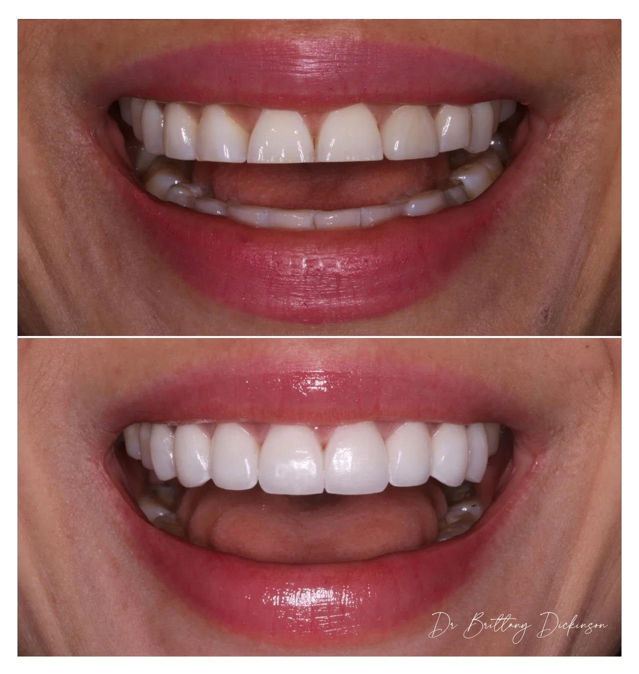 Cosmetic bonding and whitening smile makeover, Chicago Aesthetic Dentistry.