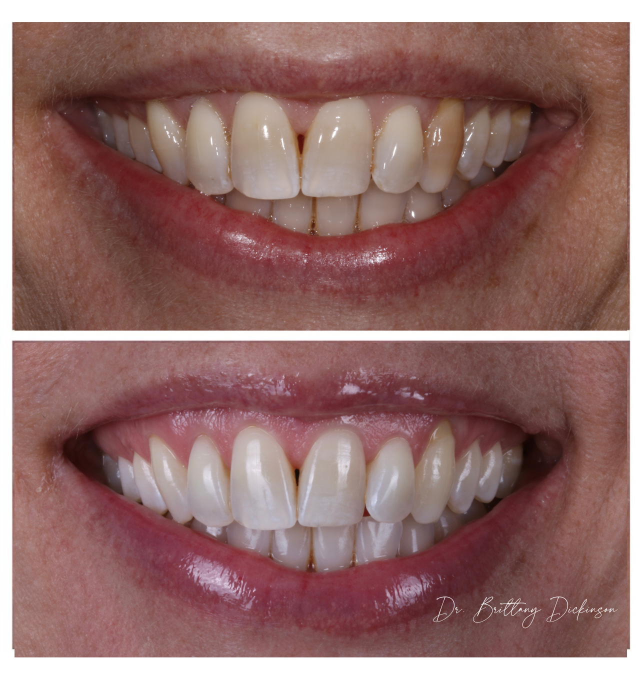 before and after of professional teeth whitening treatment at Chicago Aesthetic Dentistry, shown 8 weeks before wedding day.