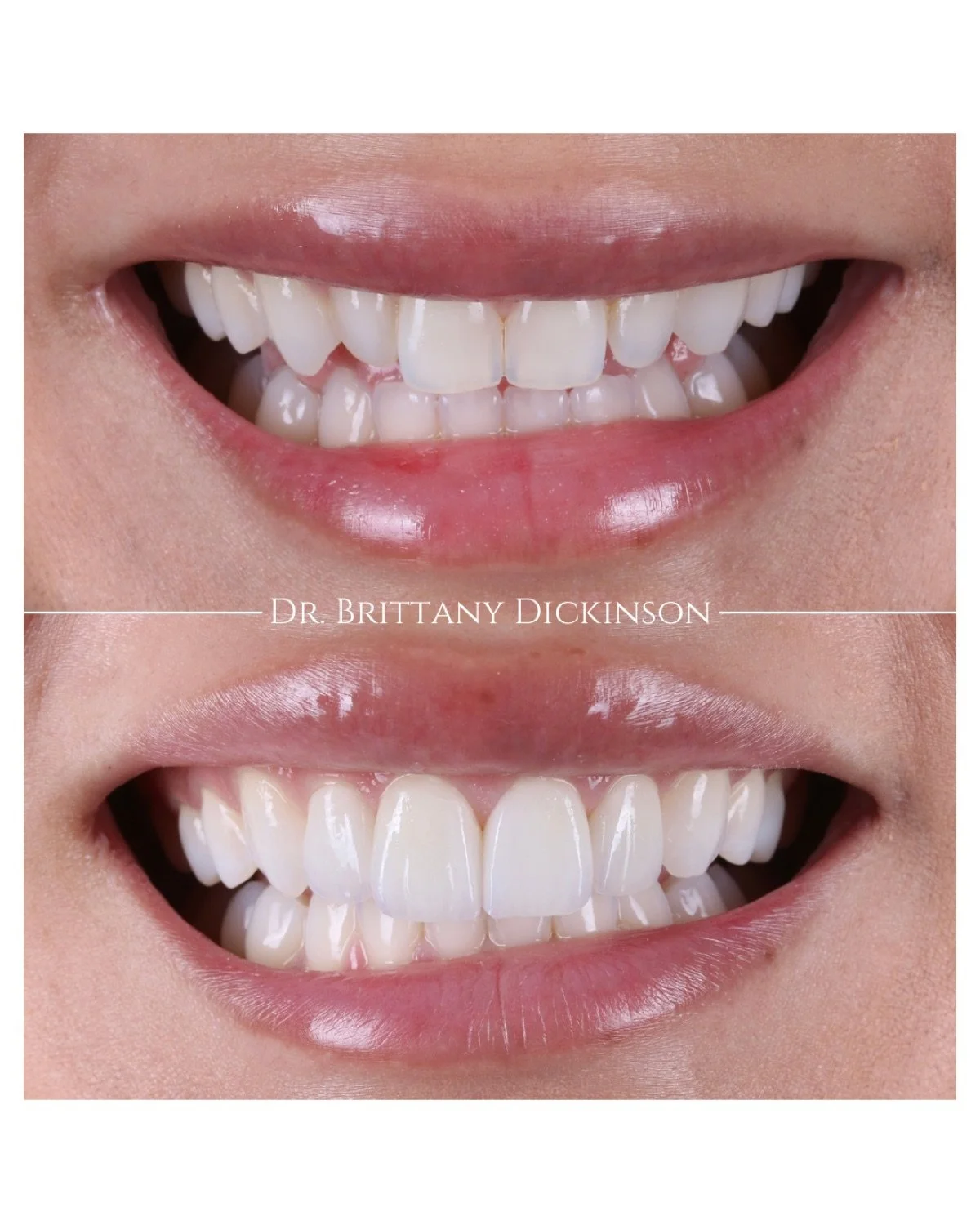 Zoom whitening and 4 porcelain veneers before and after by Dr. Brittany Dickinson, Chicago Aesthetic Dentistry, Lakeview.