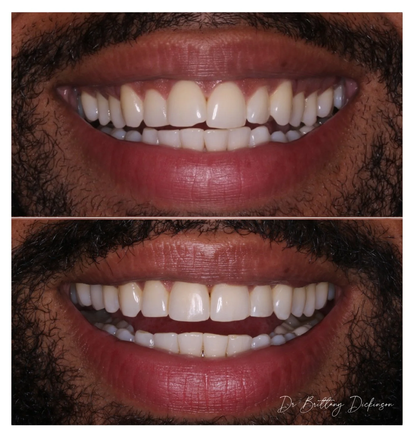 Invisalign and enameloplasty before and after by Dr. Brittany Dickinson, Chicago Aesthetic Dentistry, Lakeview.