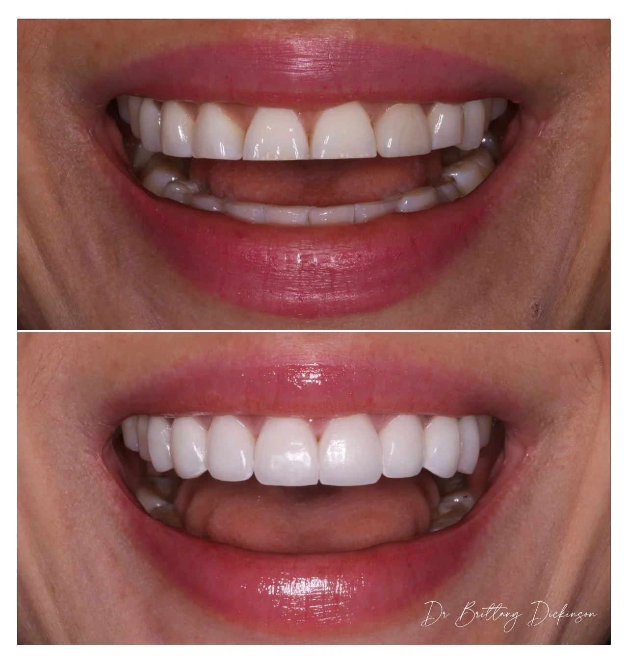 Chicago cosmetic dentist compares professional whitening shade to porcelain veneer color before designing a smile makeover.