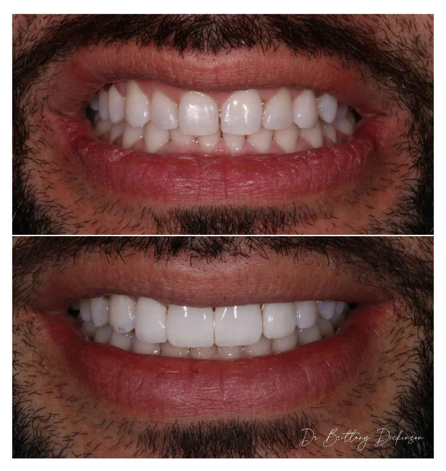 Zoom whitening and 4 porcelain veneers before and after by Dr. Brittany Dickinson, Chicago Aesthetic Dentistry, Lakeview.