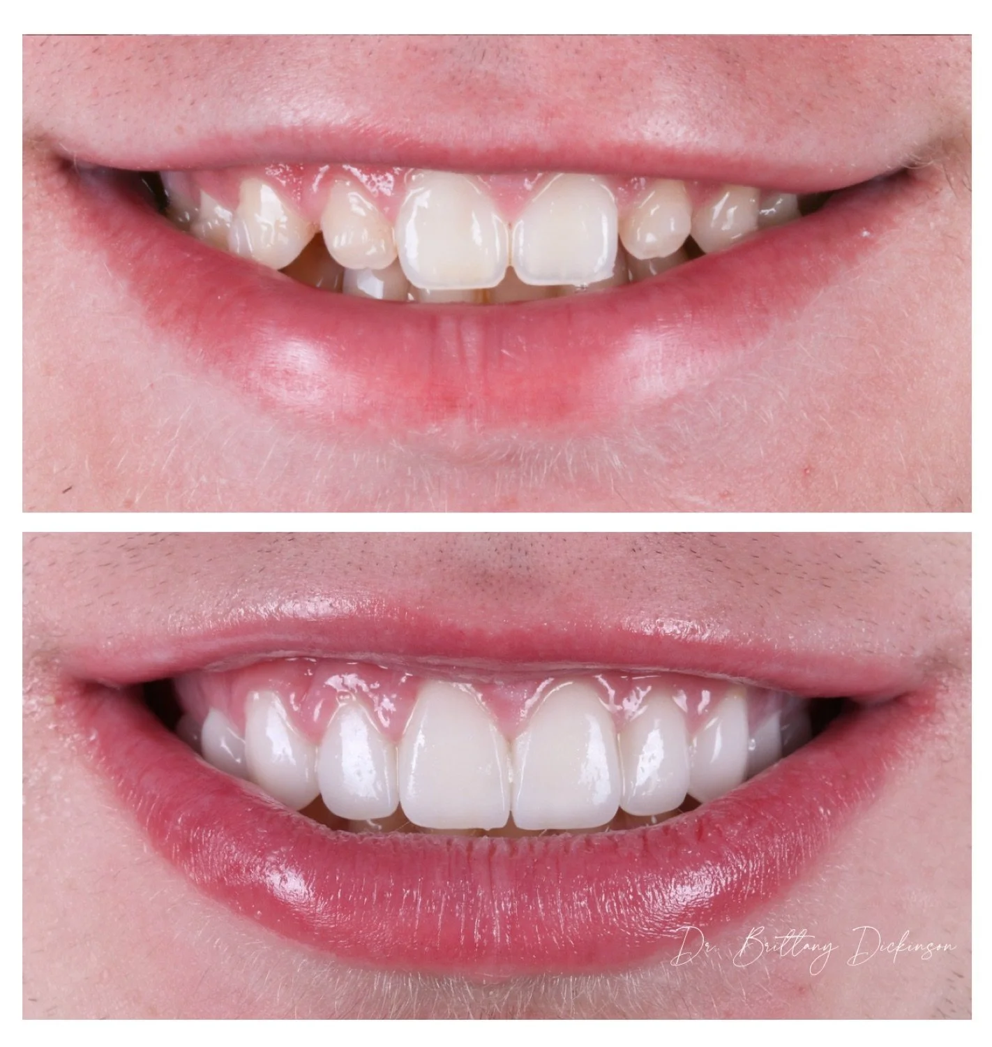 10 porcelain veneers to cover darkened front teeth before and after by Dr. Brittany Dickinson, Chicago Aesthetic Dentistry.