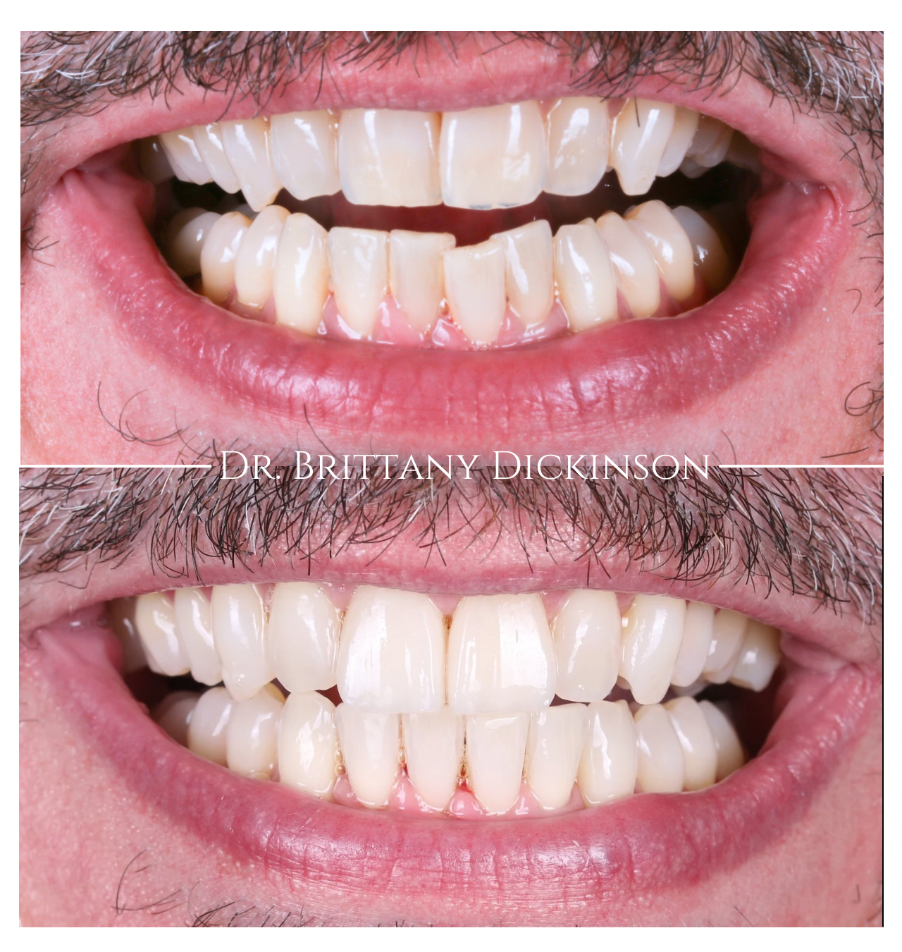 Chicago cosmetic dentist Dr. Brittany Dickinson explains why lower teeth crowd with age and how Invisalign Express fixes it — Lakeview, Chicago.