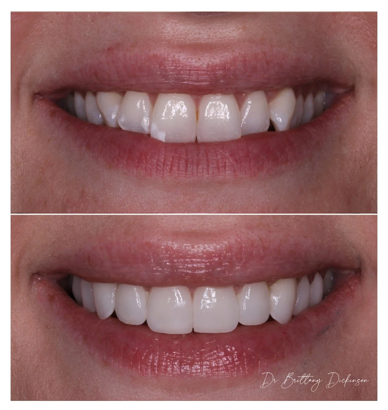 Complete smile redesign with porcelain veneers and Invisalign, Lakeview Chicago.