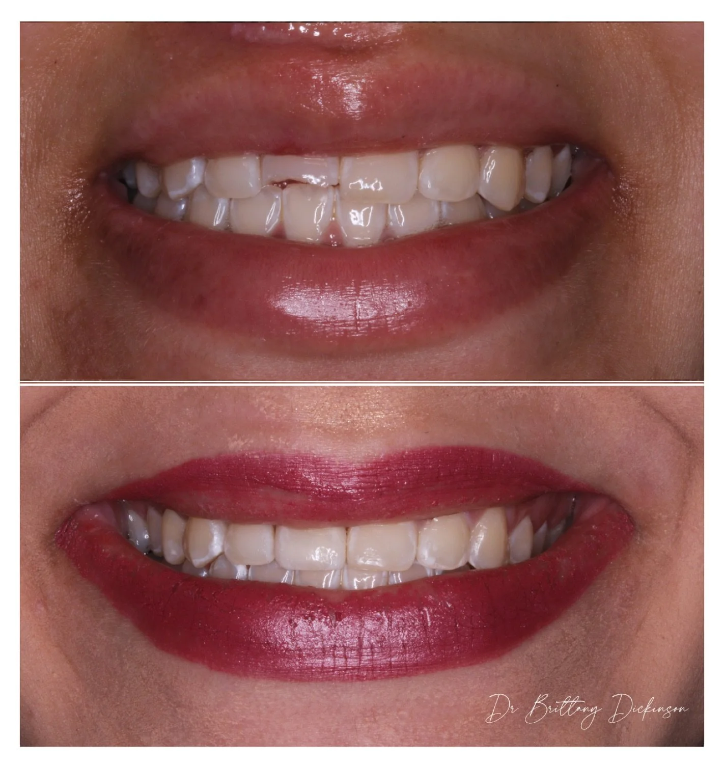 One porcelain veneer before and after by Dr. Brittany Dickinson, Chicago Aesthetic Dentistry, Lakeview.