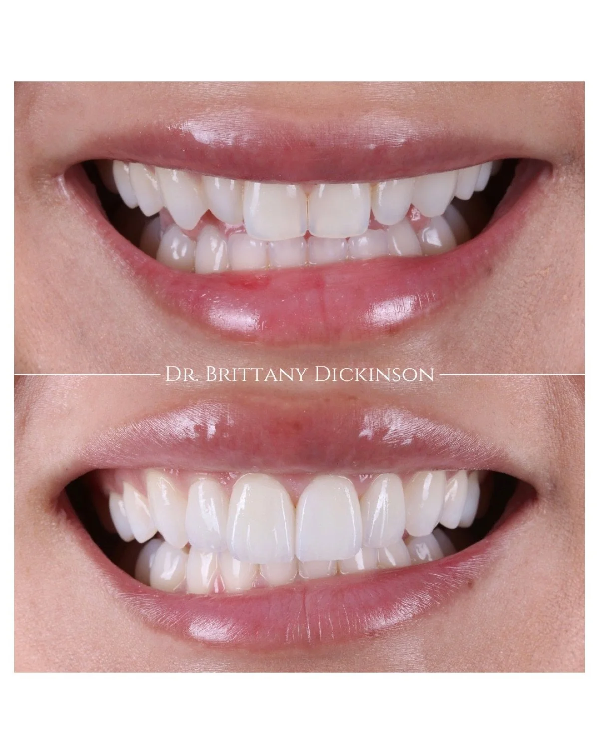 4 porcelain veneers before and after by Dr. Brittany Dickinson, Chicago Aesthetic Dentistry, Lakeview.