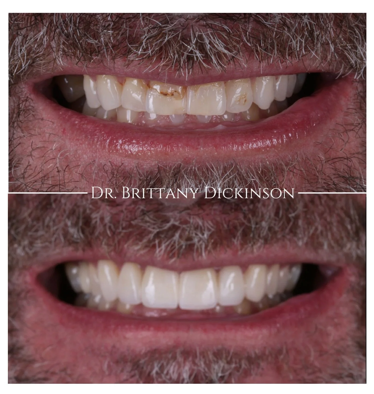 1 implant and 4 porcelain veneers before and after by Dr. Brittany Dickinson, Chicago Aesthetic Dentistry, Lakeview.