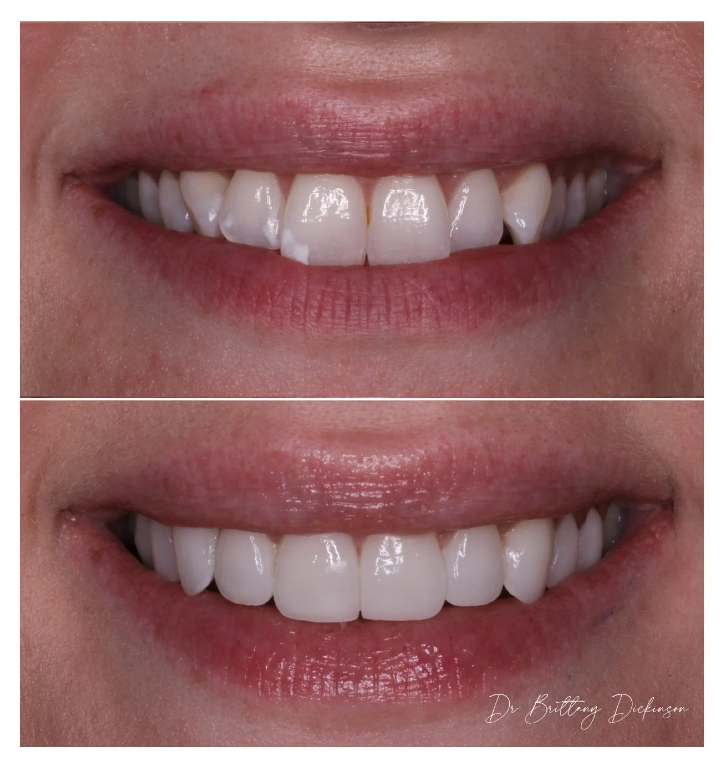 10 porcelain veneers to correct discoloration and misalignment before and after by Dr. Brittany Dickinson — Chicago Lakeview.