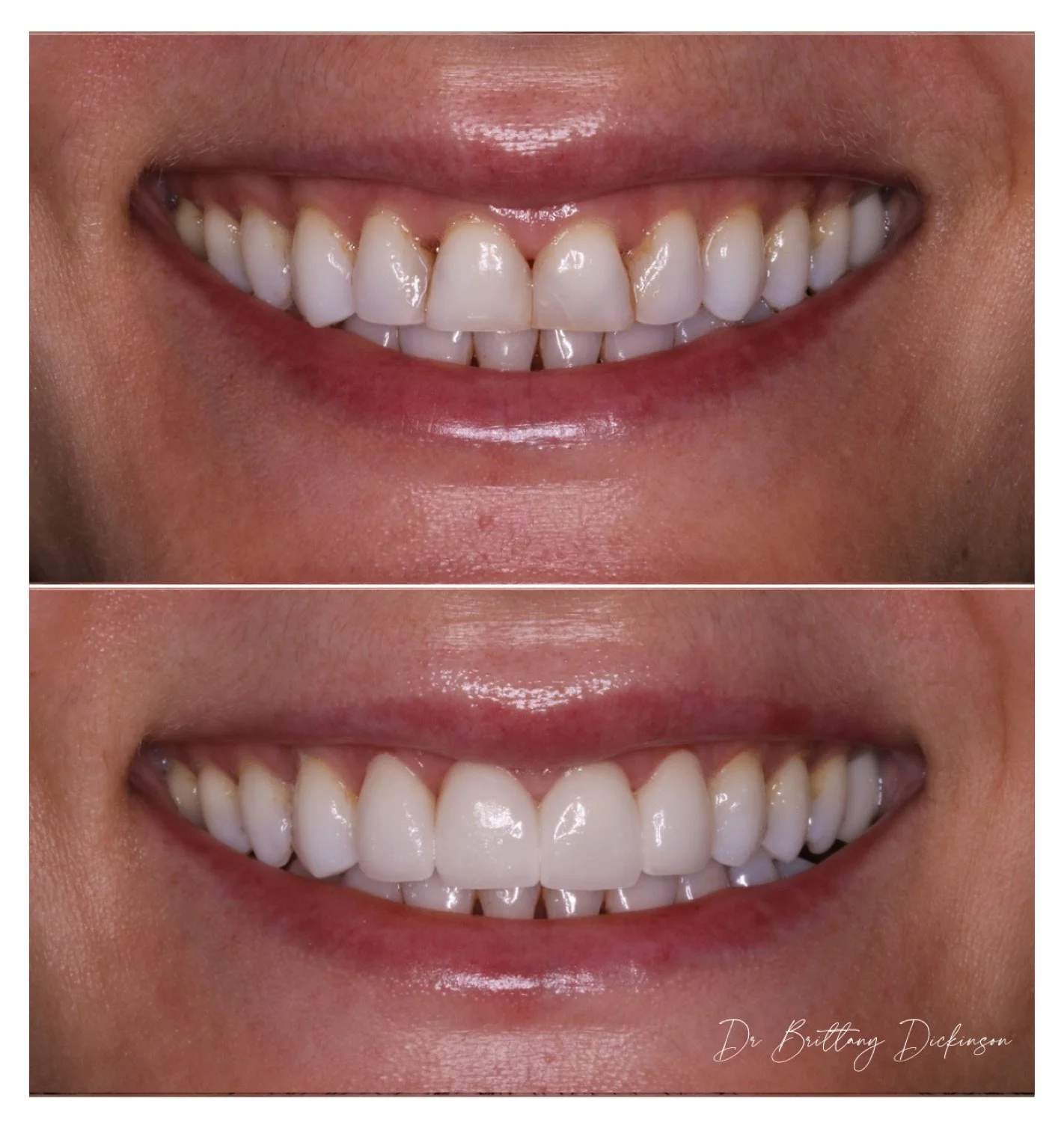 4 porcelain veneers to close gaps before and after by Dr. Brittany Dickinson, Chicago Aesthetic Dentistry, Lakeview.