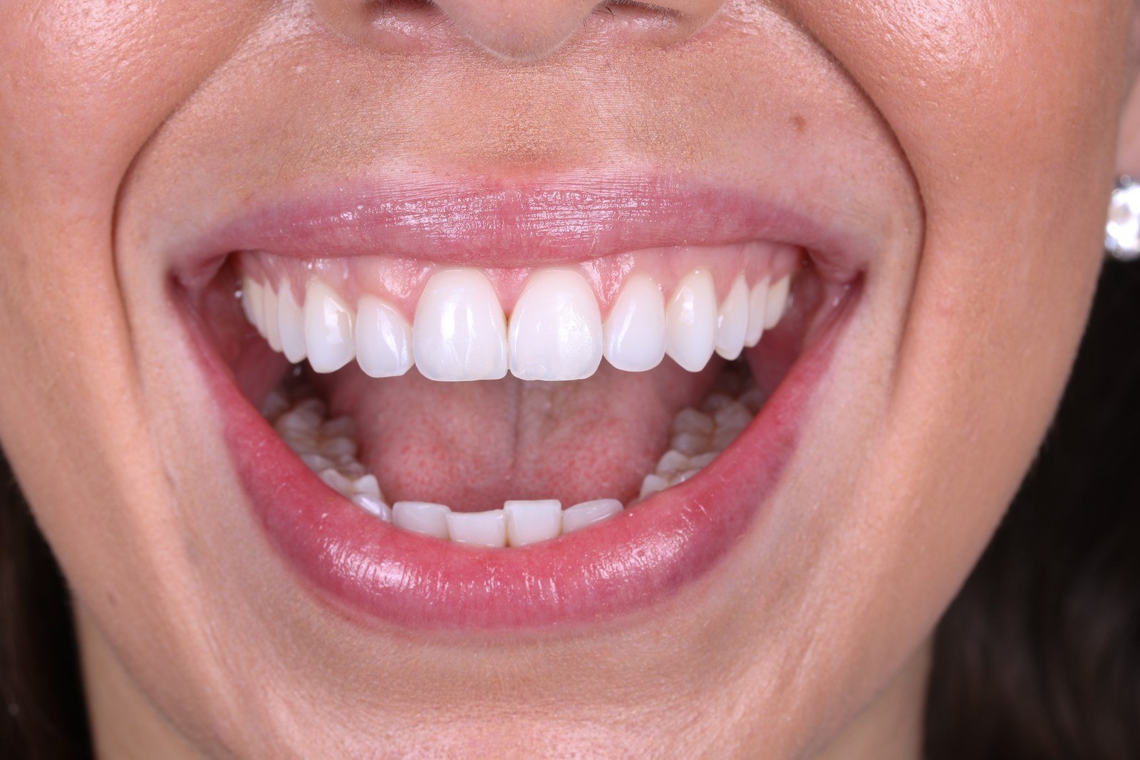 smile with crooked small teeth candidate for veneers