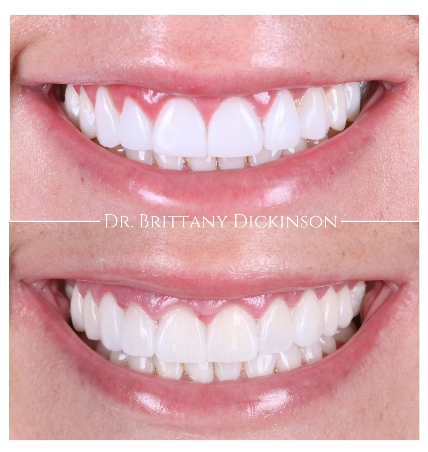 Redo of another dentist's work — 10 porcelain veneers by Dr. Brittany Dickinson, Chicago Aesthetic Dentistry, Lakeview.