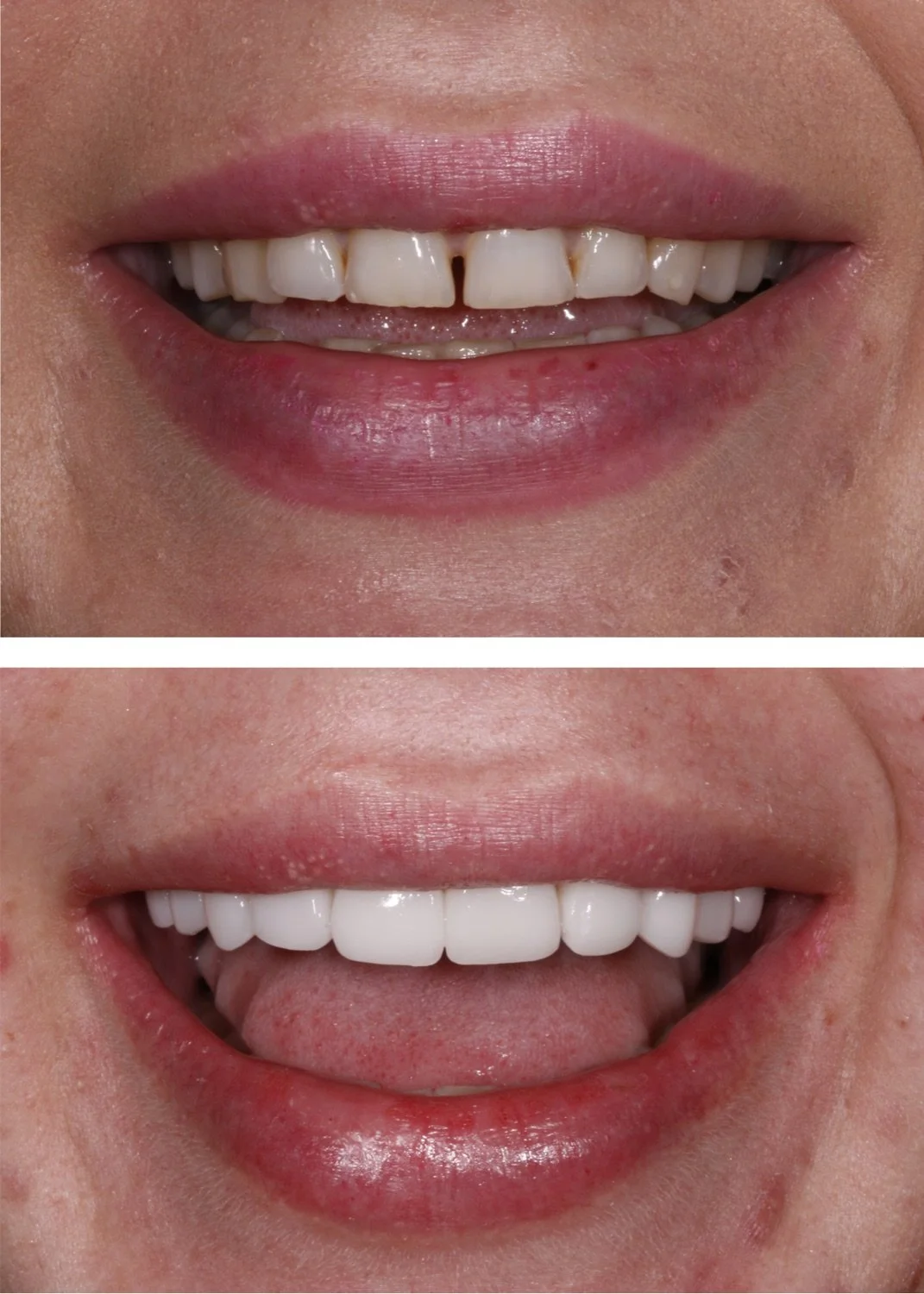 10 composite veneers before and after by Dr. Brittany Dickinson, Chicago Aesthetic Dentistry, Lakeview.