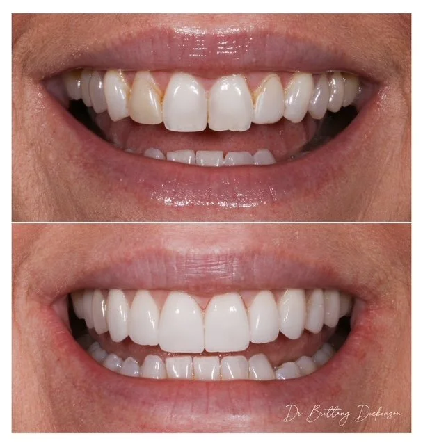 Ten Porcelain veneers refining tooth shape, shade, and smile arch on the upper teeth, before and after by Dr. Brittany Dickinson, Chicago