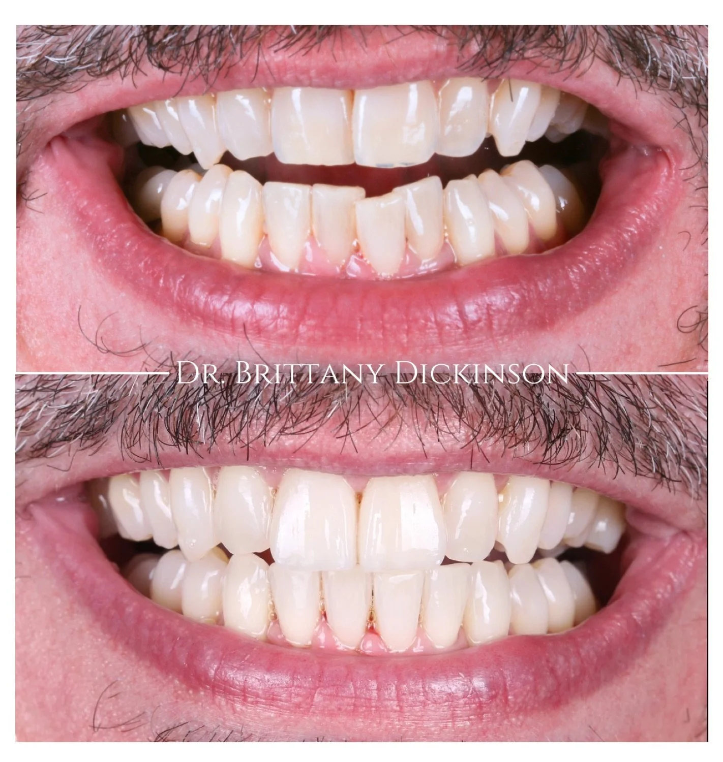 Invisalign and 2 porcelain veneers before and after by Dr. Brittany Dickinson, Chicago Aesthetic Dentistry, Lakeview.
