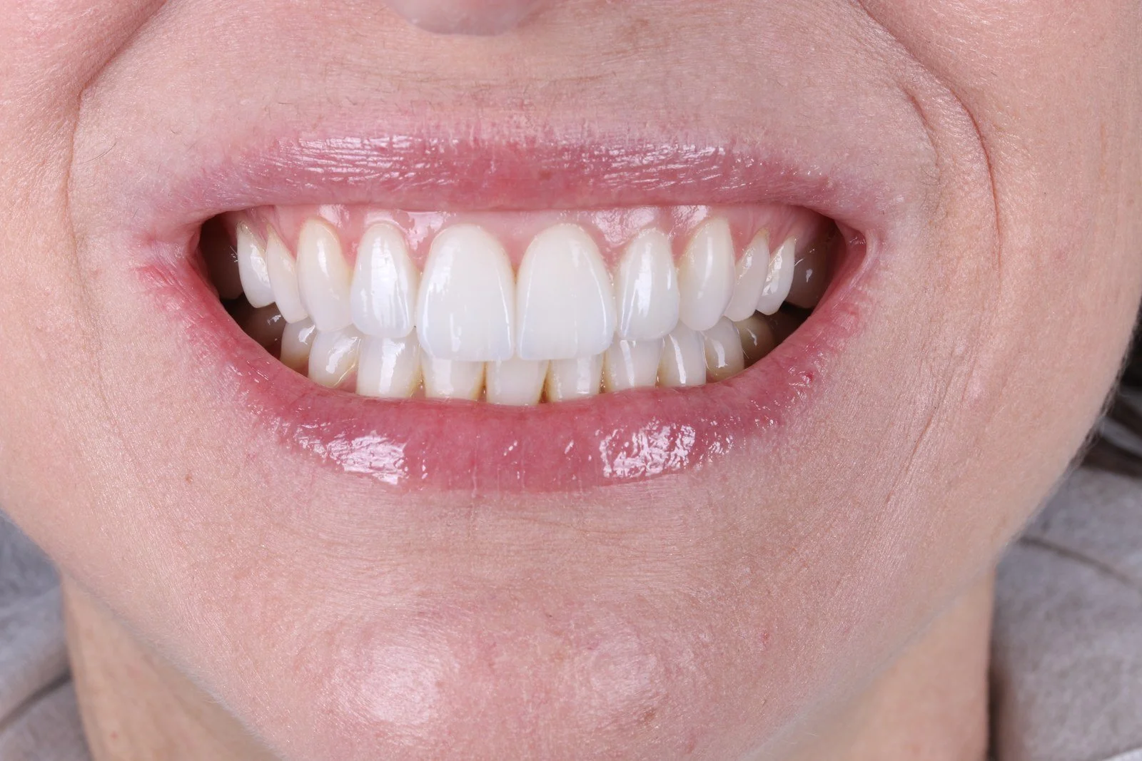teeth whitening before fall event Chicago