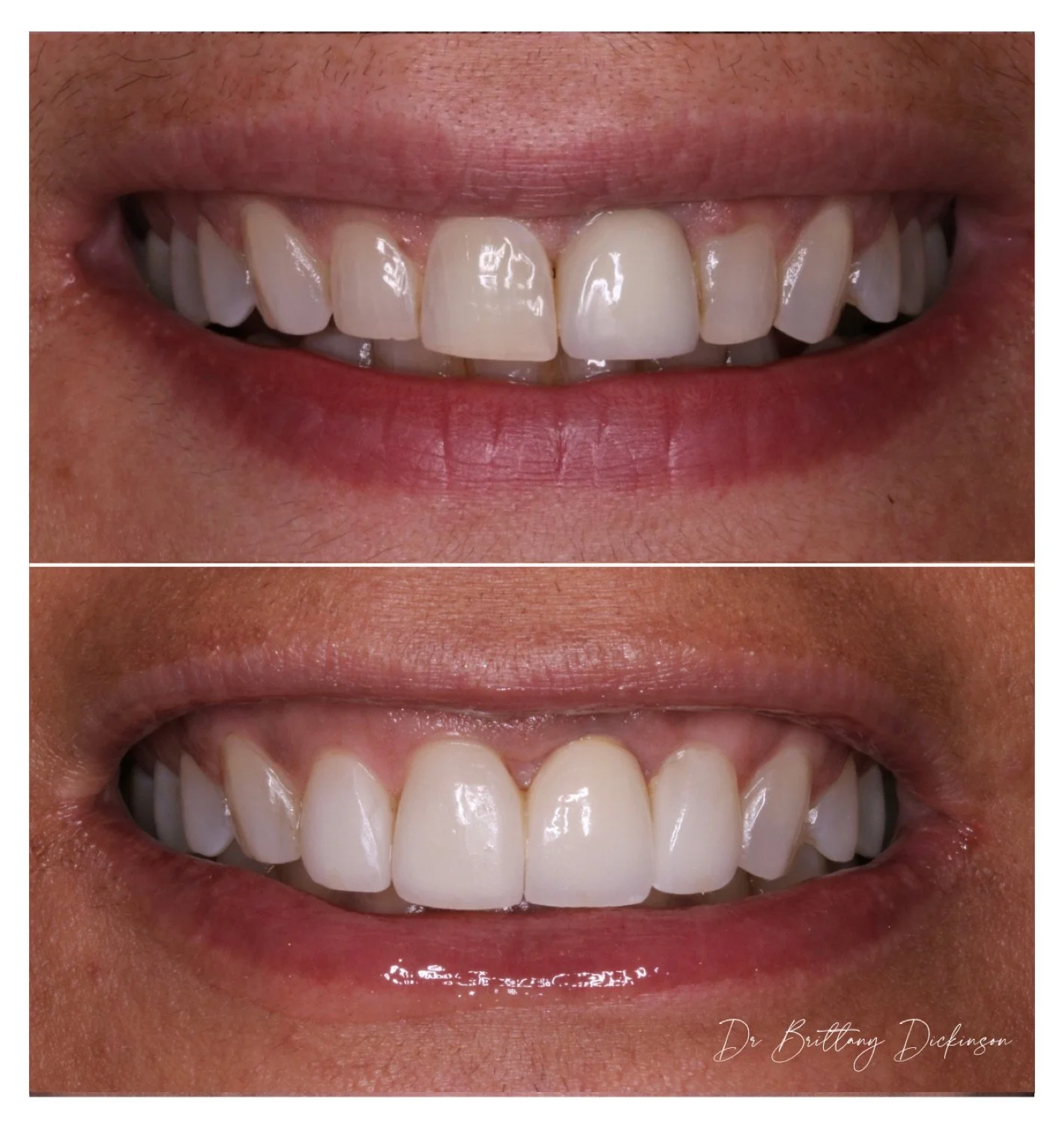 One implant and 4 porcelain veneers before and after by Dr. Brittany Dickinson, Chicago Aesthetic Dentistry, Lakeview.