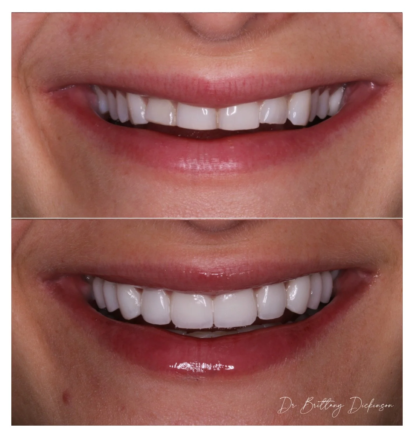10 porcelain veneers to restore severe wear and crowding before and after by Dr. Brittany Dickinson — Chicago Lakeview.