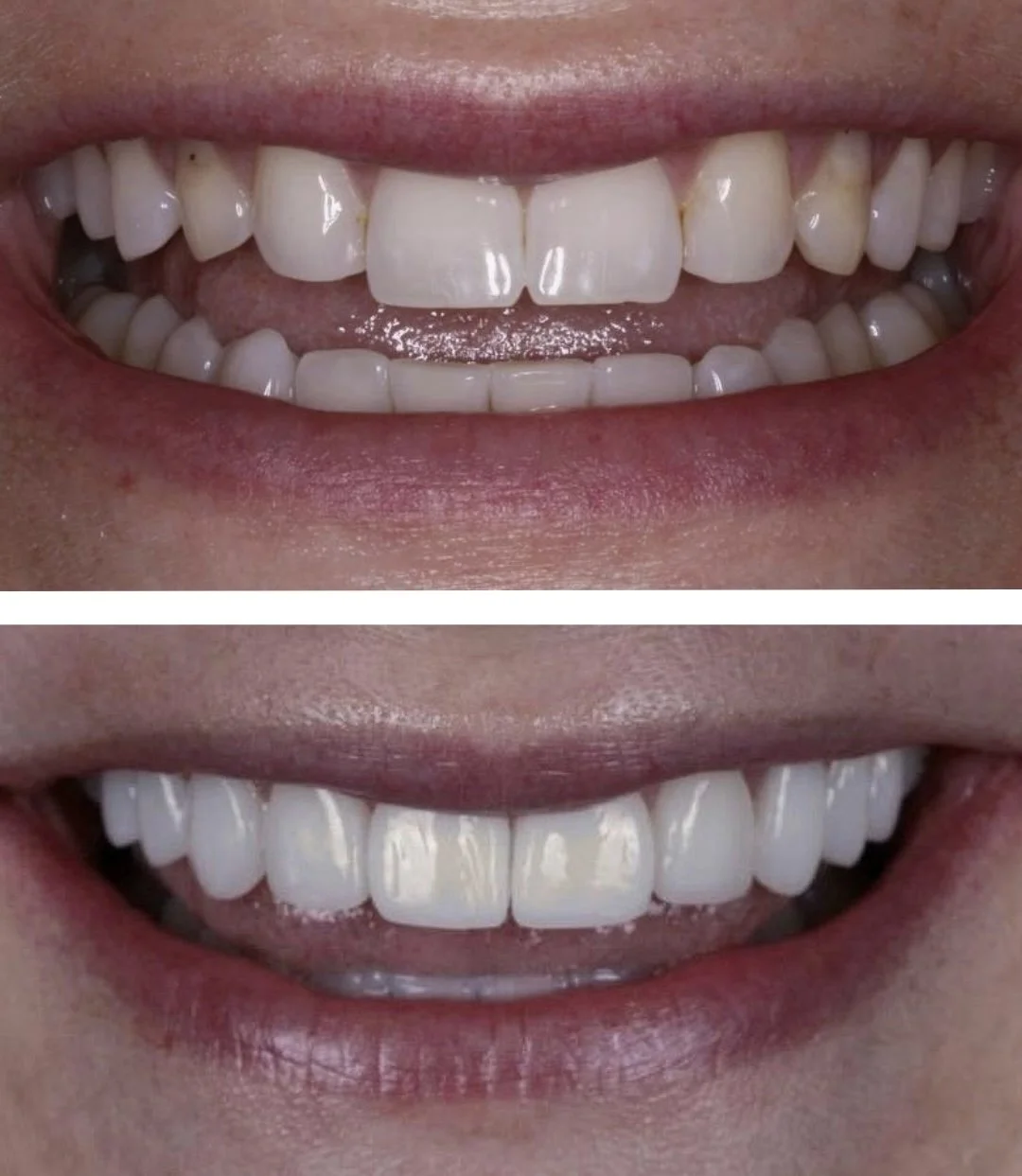Side-by-side before and after of a no-prep veneers case in Chicago — old bonding on baby teeth on the left, ultra-thin porcelain-composite hybrid veneers on the right.