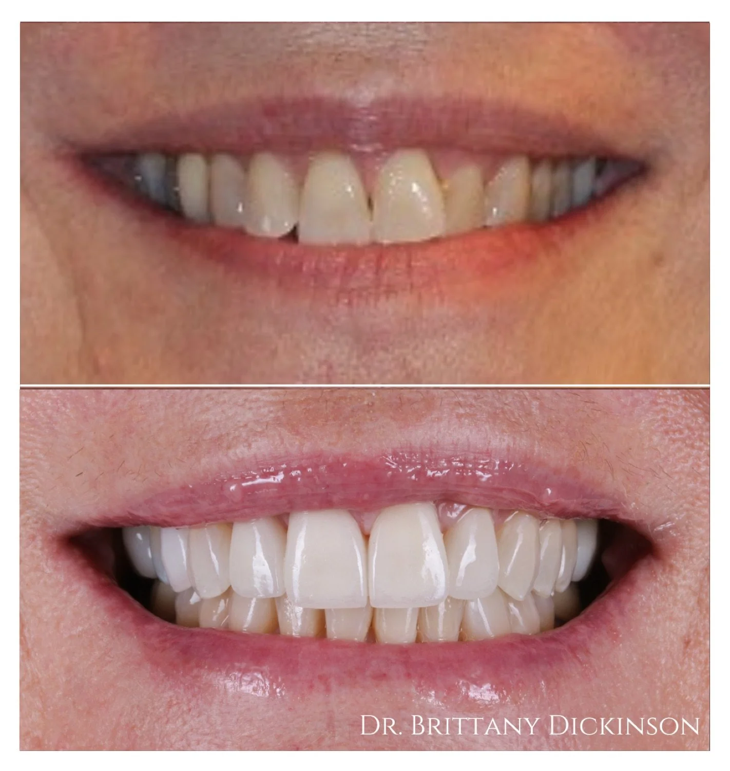 Invisalign zoom and 4 porcelain veneers before and after by Dr. Brittany Dickinson, Chicago Aesthetic Dentistry, Lakeview.