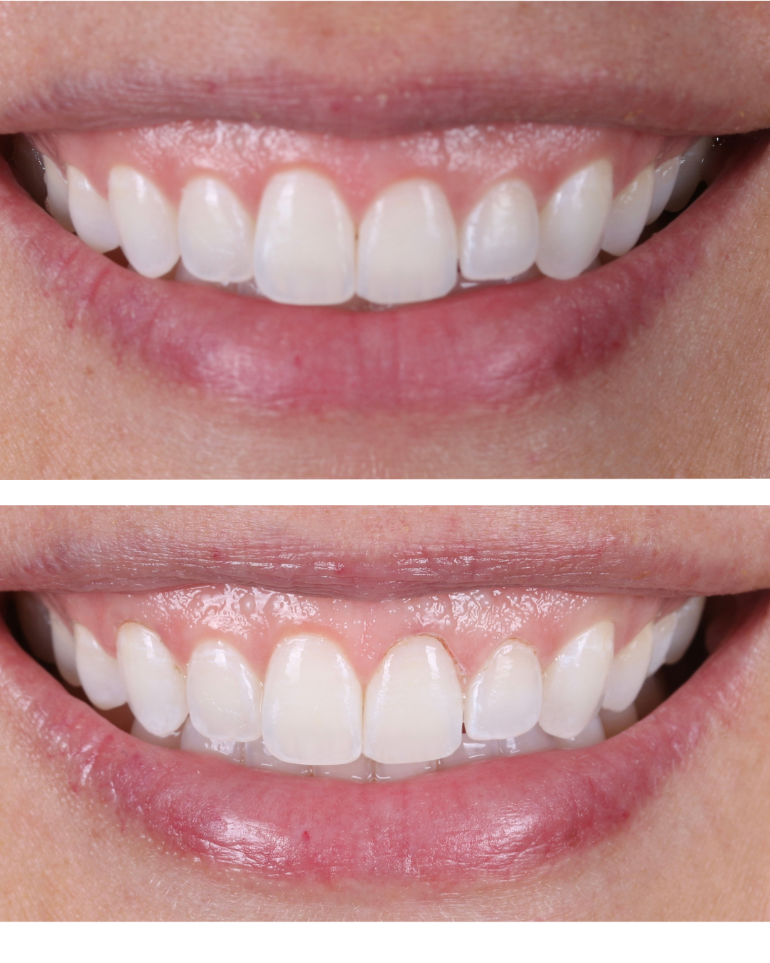 Before and after gum contouring and veneers by Dr. Brittany Dickinson at Chicago Aesthetic Dentistry in Lakeview.