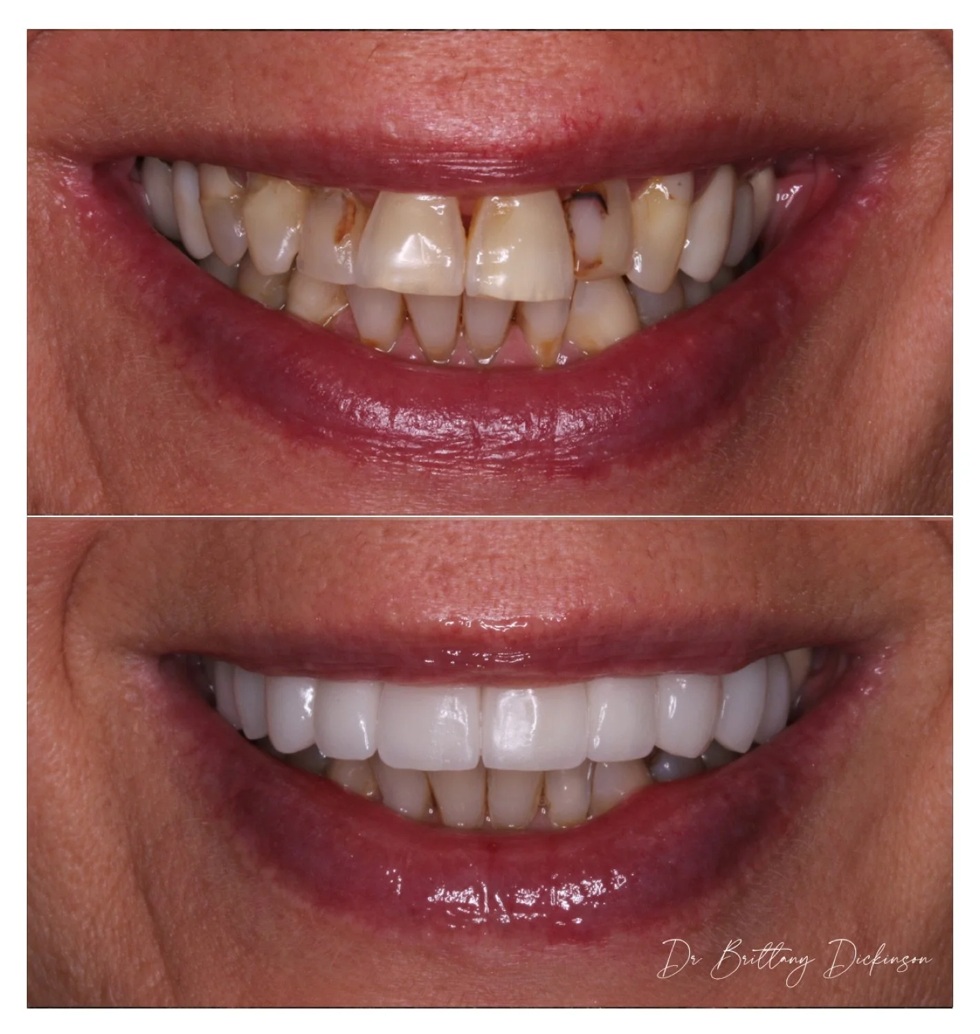 12 porcelain veneers and crowns before and after by Dr. Brittany Dickinson, Chicago Aesthetic Dentistry, Lakeview.