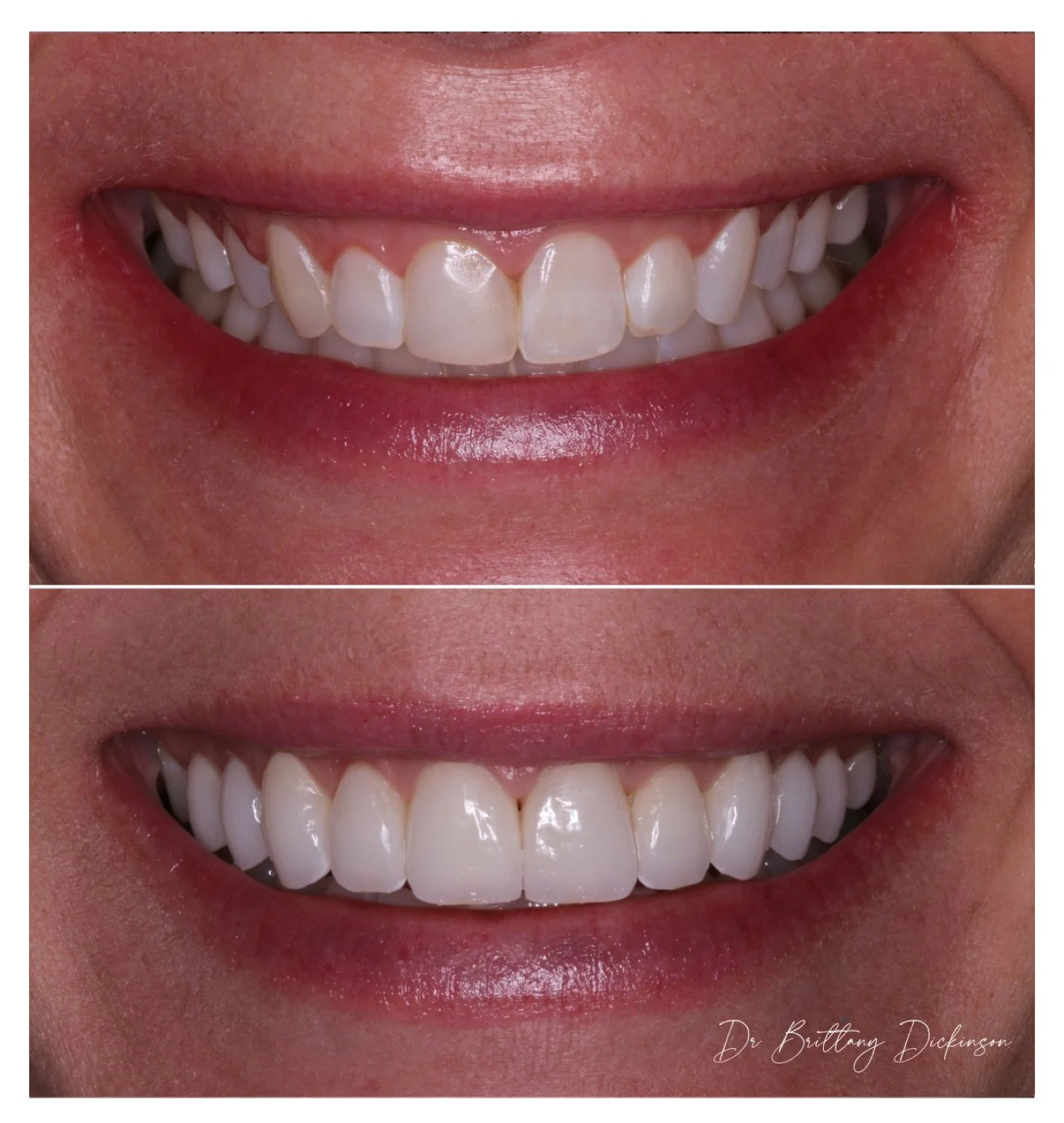 Gingivectomy and 10 porcelain veneers before and after by Dr. Brittany Dickinson, Chicago Aesthetic Dentistry, Lakeview.