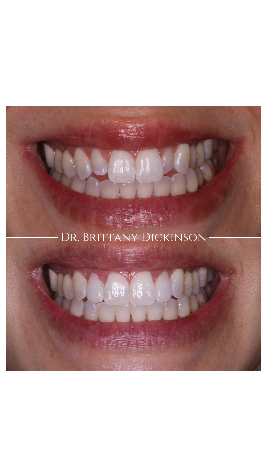 Two porcelain veneers correcting small peg-shaped lateral teeth for a balanced symmetrical smile, before and after by Dr. Brittany Dickinson, Chicago