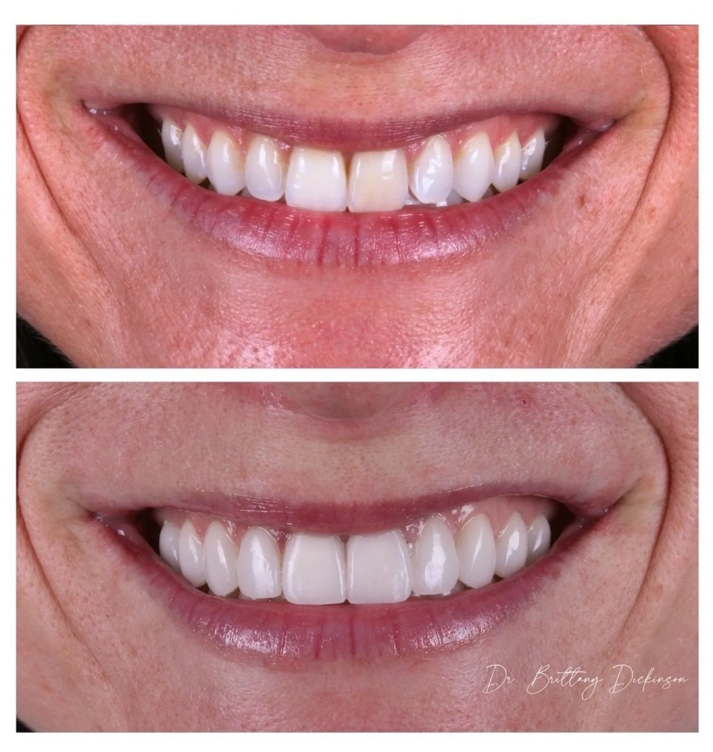 10 porcelain veneers before and after by Dr. Brittany Dickinson, Chicago Aesthetic Dentistry, Lakeview.