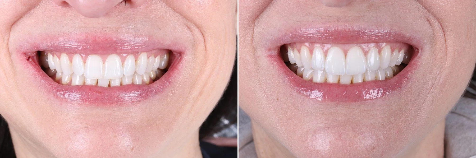 Porcelain veneers before and after — Chicago cosmetic dentist Dr. Brittany Dickinson smile transformation
