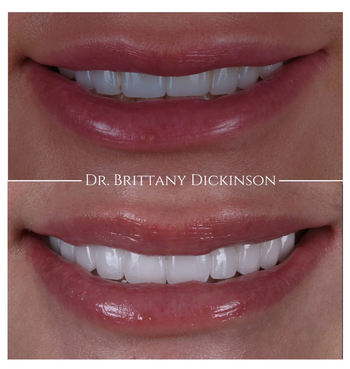 Redo of another dentist's work — 12 porcelain veneers + bridge for missing laterals by Dr. Brittany Dickinson, Chicago.