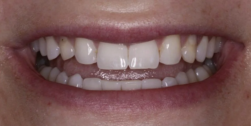 Close-up smile of a Chicago Aesthetic Dentistry patient before no-prep veneers, showing worn bonding on retained baby teeth with mismatched shades and stepped incisal edges.