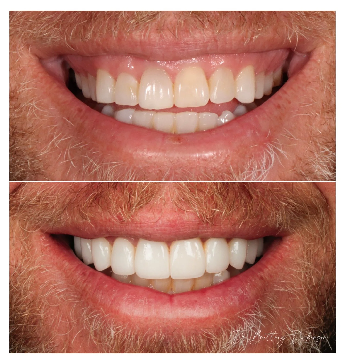 12 porcelain veneers before and after by Dr. Brittany Dickinson, Chicago Aesthetic Dentistry, Lakeview.