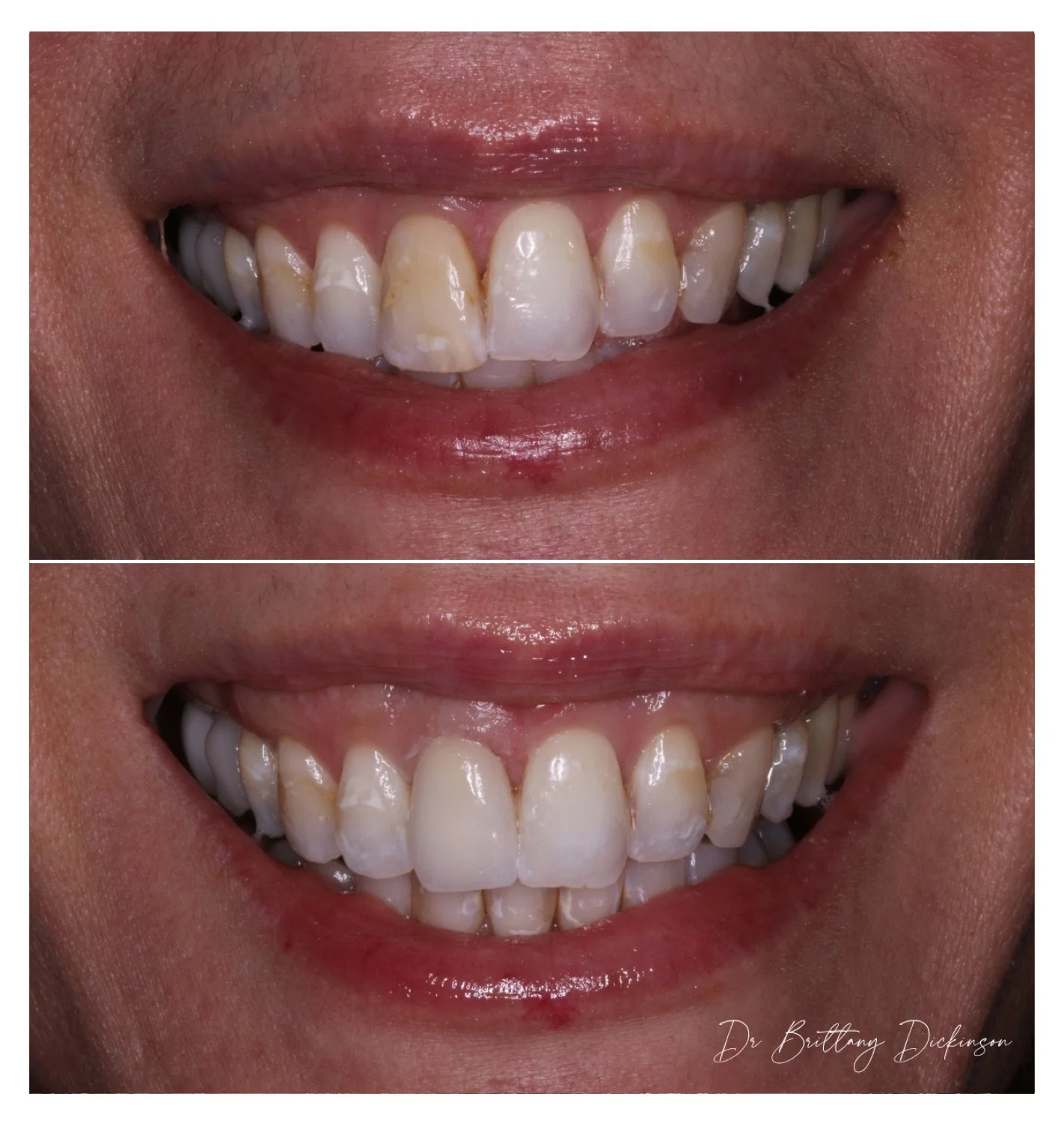 One porcelain veneer to brighten root canaled front tooth before and after by Dr. Brittany Dickinson — Chicago Lakeview.