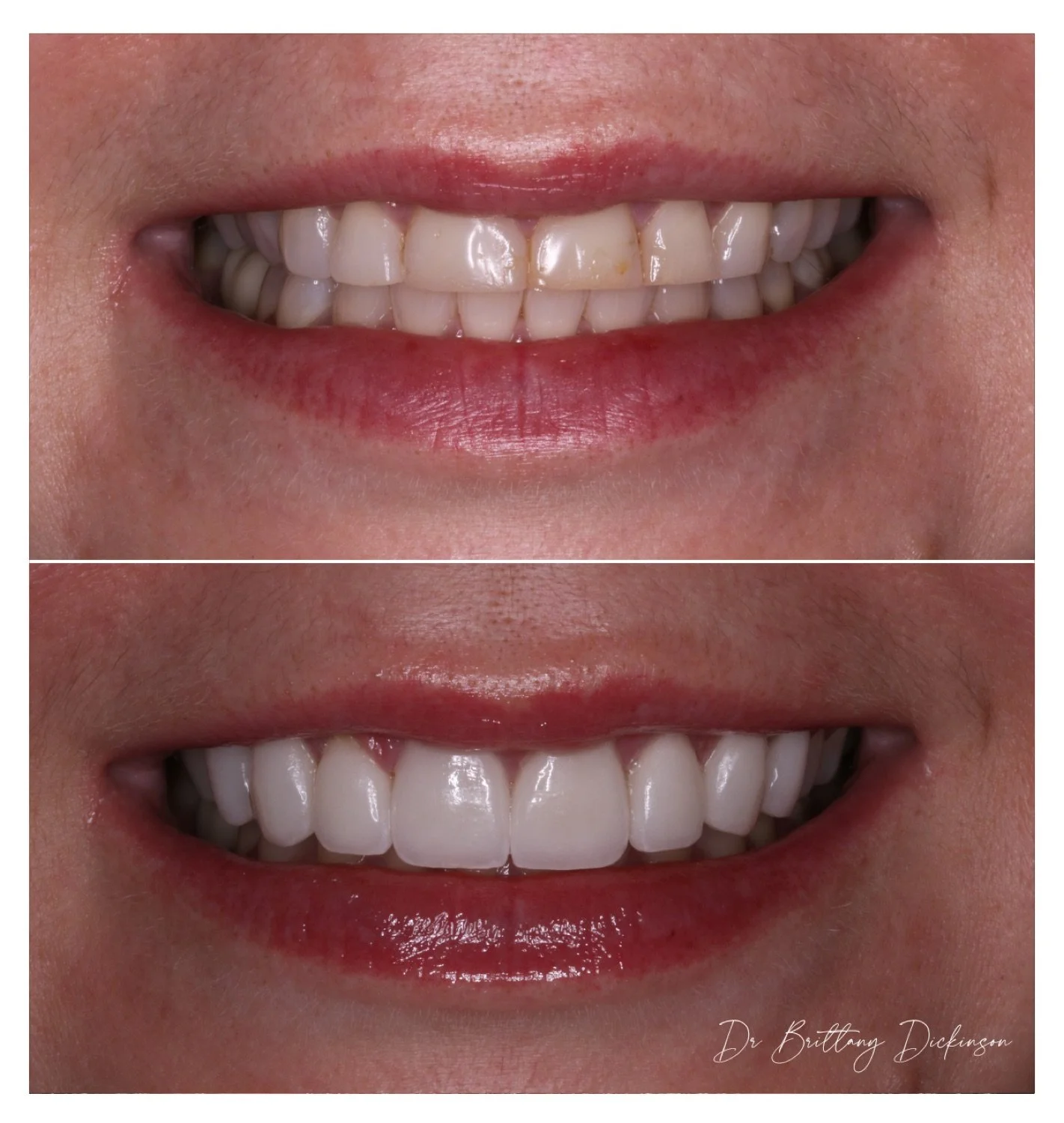12 porcelain veneers to restore lost teeth and brighten color before and after by Dr. Brittany Dickinson — Chicago Lakeview.