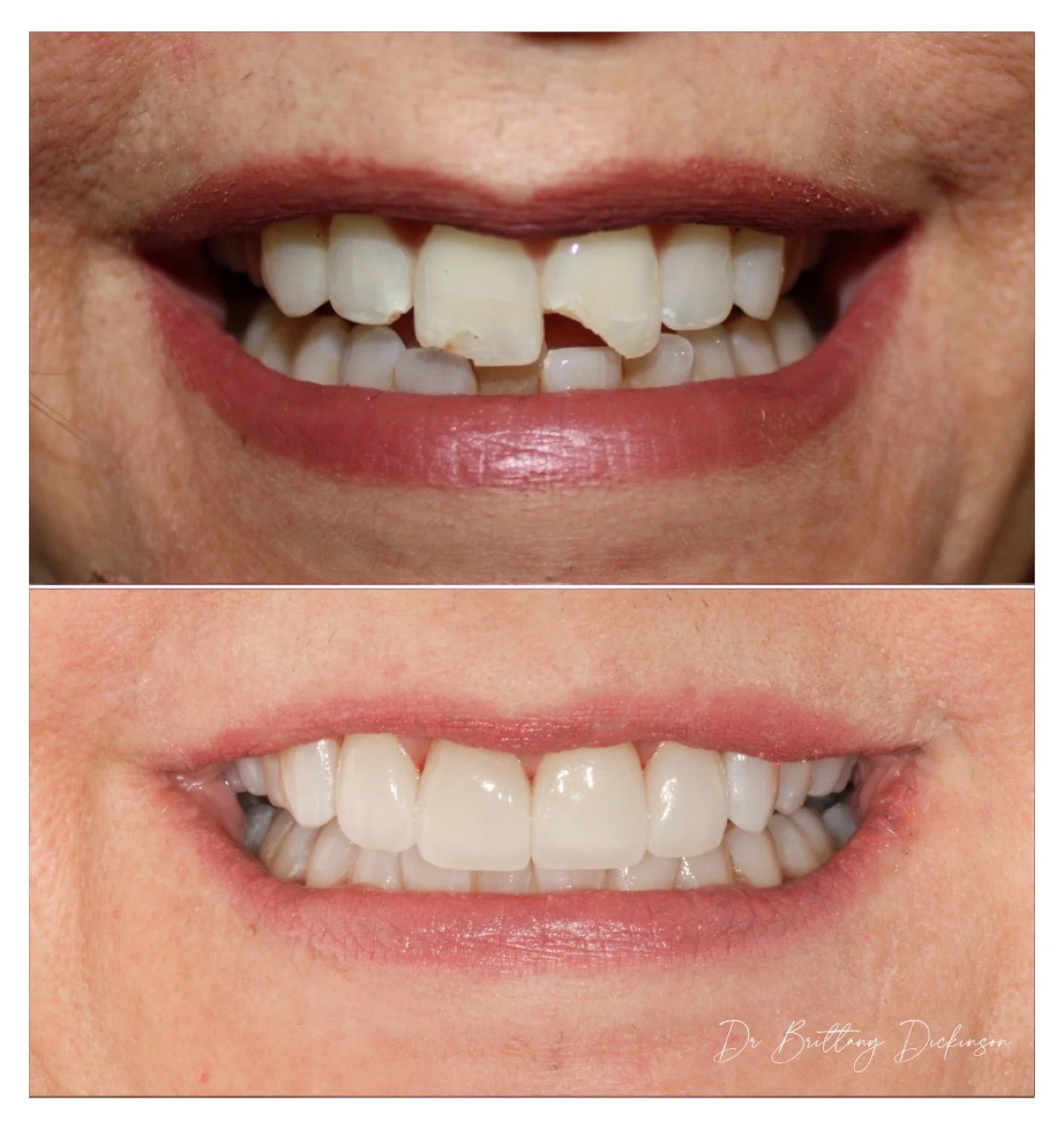 4 porcelain veneers to restore after accident before and after by Dr. Brittany Dickinson, Chicago Aesthetic Dentistry.