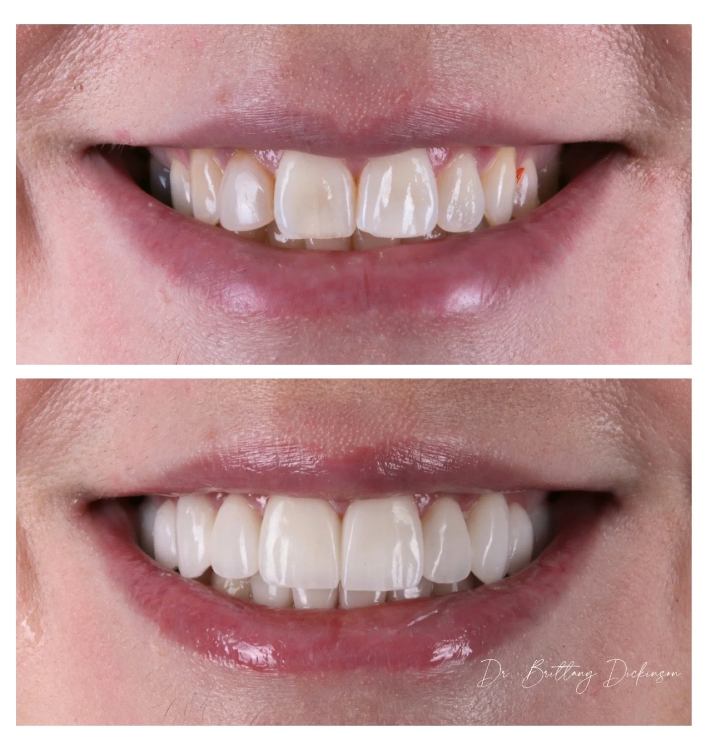 14 porcelain veneers before and after by Dr. Brittany Dickinson, Chicago Aesthetic Dentistry, Lakeview.