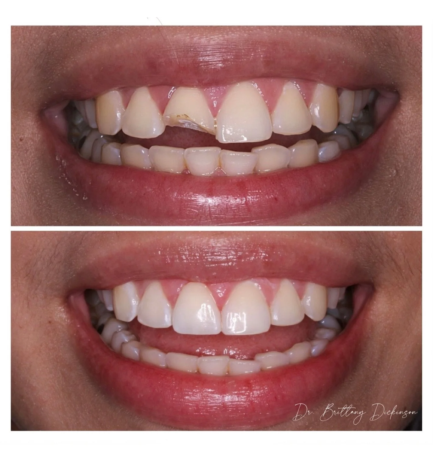 Zoom whitening and 1 porcelain veneer before and after by Dr. Brittany Dickinson, Chicago Aesthetic Dentistry.