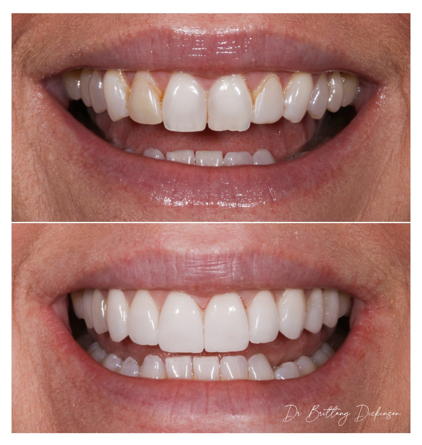 10 porcelain veneers before and after by Dr. Brittany Dickinson, Chicago Aesthetic Dentistry, Lakeview.
