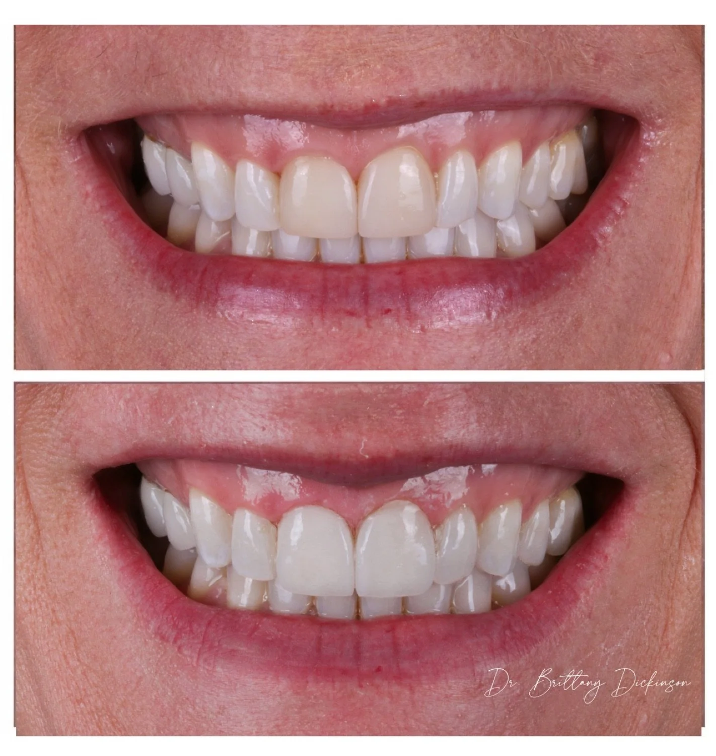 gingivectomy and replacing 2 porcelain veneers that were 10 years old by cosmetic dentist Dr. Brittany Dickinson in Lakeview Chicago.